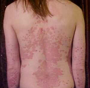 Read more about the article What is Psoriasis सोरायसिस? Meaning in Hindi & Ayurvedic Home Remedies